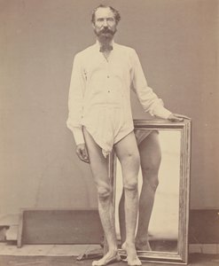 Střelná rána střední třetiny levé stehenní kosti, 1865-67.
