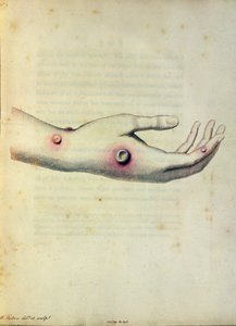 Puchlina kravských neštovic na paži Sarah Nelmes, z „An Inquiry to the Causes and Effects of Variolae Vaccinae“ od Edwarda Jennera (1749-1823), vyryto Pearcem, kolem roku 1800