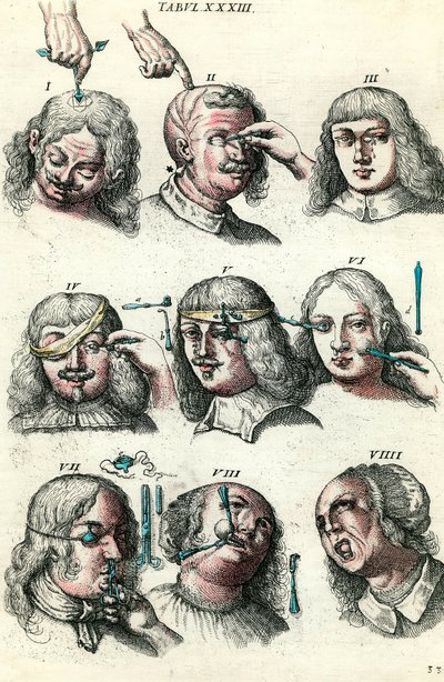 Chirurgie v 18. století: Trepanace a operace oka a obličeje. Rytina v „Institutions chirurgicale“ od Lorenze Heistera od Anonymous Anonymous