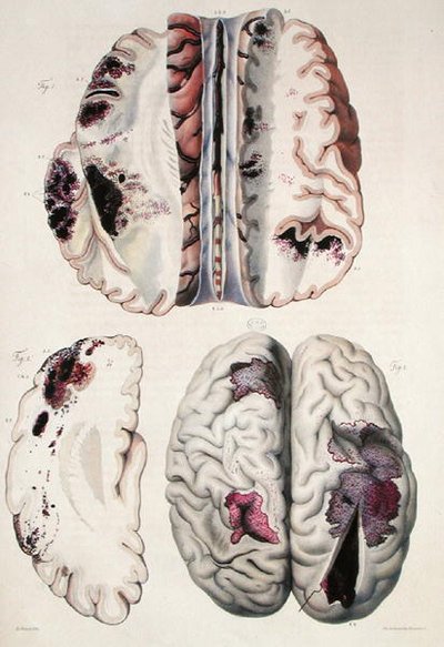 Kapilární apoplexie, z „Anatomie Pathologique du Corps Humain“ od Jean Cruveilhier (1791-1874) 1828-42 (barevná rytina) od Antoine Chazal