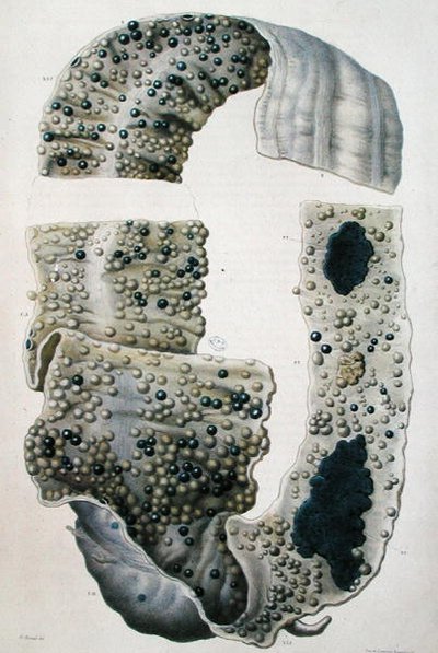 Nemoci střev, z „Anatomie Pathologique du Corps Humain“ od Jean Cruveilhier (1791-1874) 1828-42 (barevná rytina) od Antoine Chazal