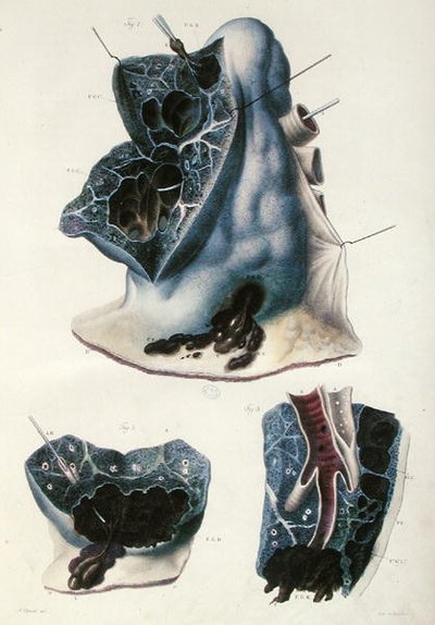 Nemoci plic, z „Anatomie Pathologique du Corps Humain“ od Jean Cruveilhier (1791-1874) 1828-42 (barevná rytina) od Antoine Chazal