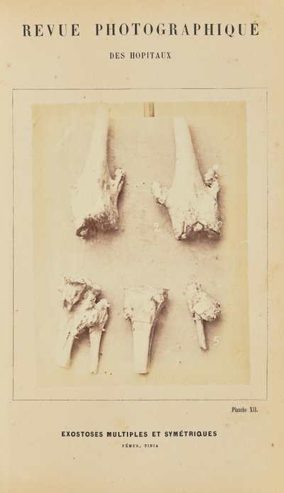 Mnohočetné symetrické exostózy, femur, tibie od Arthur de Montmeja