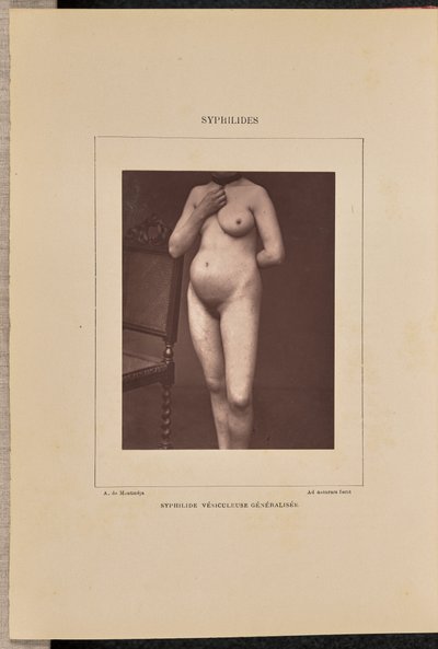 Generalizovaná vezikulární syfilis od Arthur de Montmeja