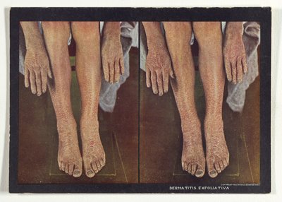 Dermatitis exfoliativa od Dr. Selden I. Rainforth