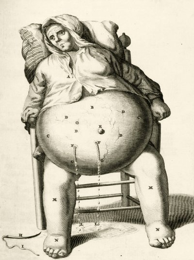 Vypouštění tekutin z abscesu Frederik Dekkers, 1694 od Dutch School