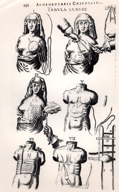 Operace rakoviny prsu, od Armamentarii Chirurgici od Johannese Schultese (1595-1645), publikované v Amsterdamu, 1672 od Dutch School