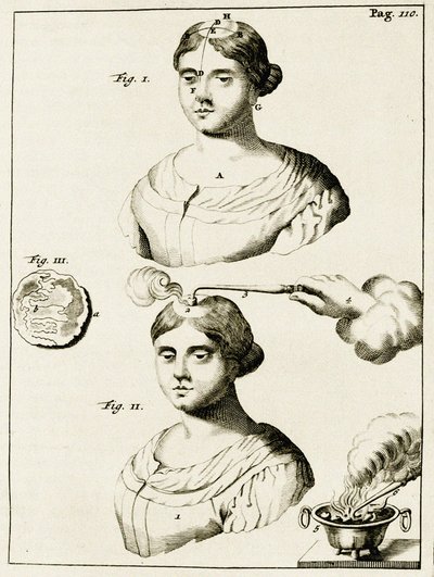Léčba pacienta trpícího epilepsií z cvičení v lékařské praxi Frederik Dekkers, 1694 od Dutch School