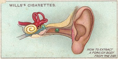 Cizí těleso v uchu, ne. 30 ze série cigaretových karet Willss First Aid, 1913 od English School