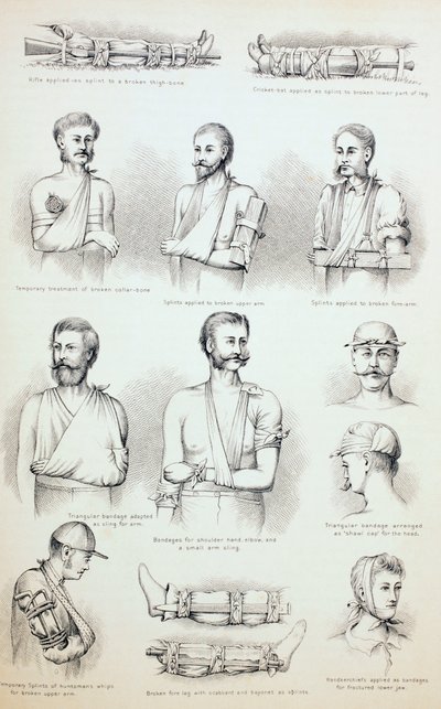 Dočasná léčba zlomenin, c.1890 od English School