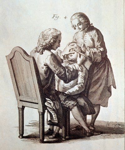 Lékař operující pacienta se šedým zákalem, ilustrace z Lékařské encyklopedie Denise Diderota a Jeana le Ronda d