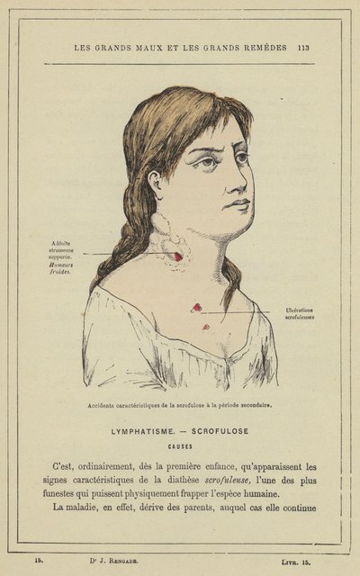 Charakteristické příhody skrofulózy v sekundárním období (barevné lito) od French School