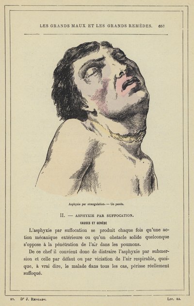 Udušení udušením, oběšený muž (barva lito) od French School