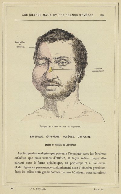Progresivní obličejový erysipel (barevné lito) od French School