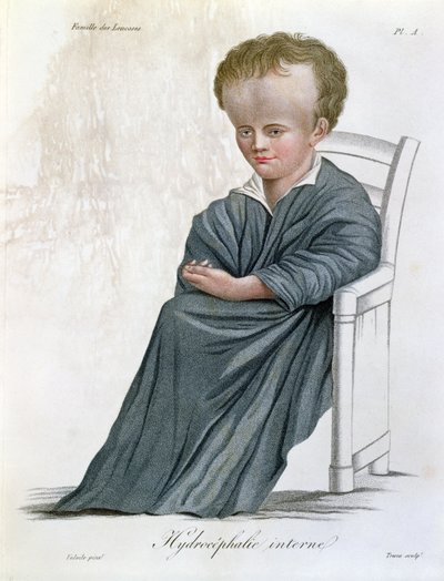 Vnitřní hydrocefalus, z Nosologie Naturelle od barona Jean Louis Alibert (1768-1837), rytý Trescou, 1817 od French School