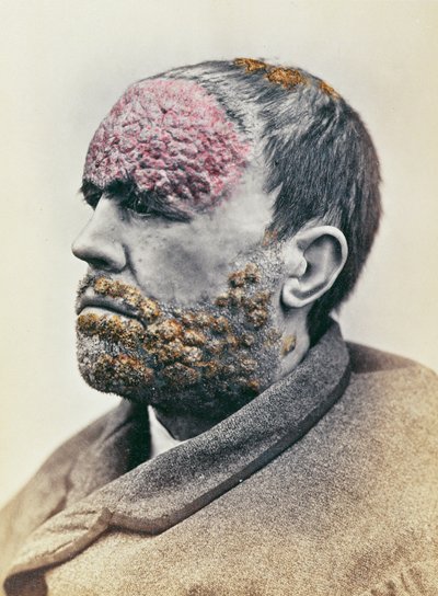 Muž trpící syfilidou, z fotografie pořízené pro Clinique Photographique de lHopital Saint-Louis, 1868 od French School