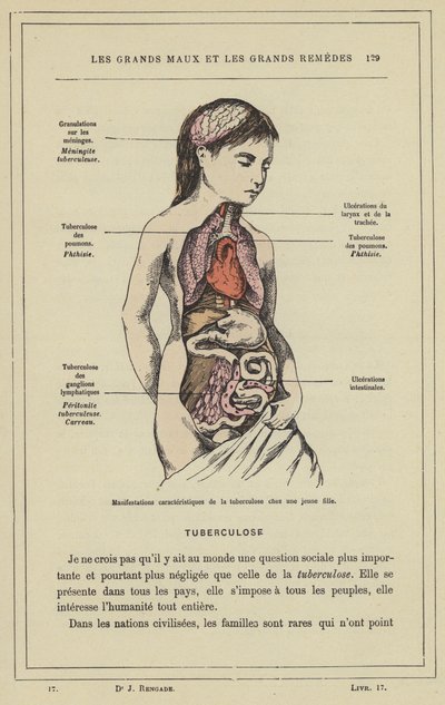 Charakteristické projevy tuberkulózy u mladé dívky (barevné lito) od French School