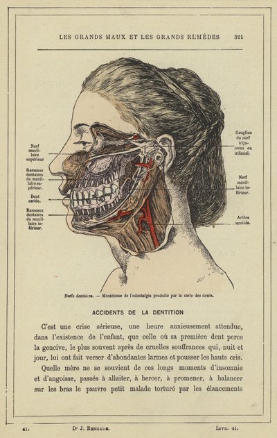 Zubní nervy, Mechanismus odontalgie produkovaný zubním kazem (barevné lito) od French School