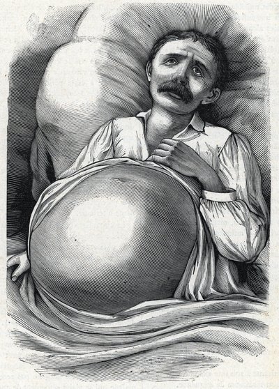 Pacient s pokročilou cirhózou jater (rytina) 1888 od French School