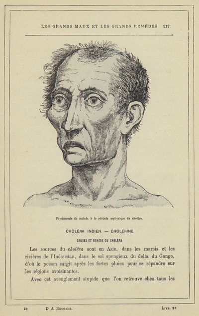 Fyziognomie pacienta během asfyxického období cholery (barevné lito) od French School