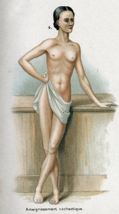 Portrét ženy s kachektickým úbytkem hmotnosti (tisk) od French School