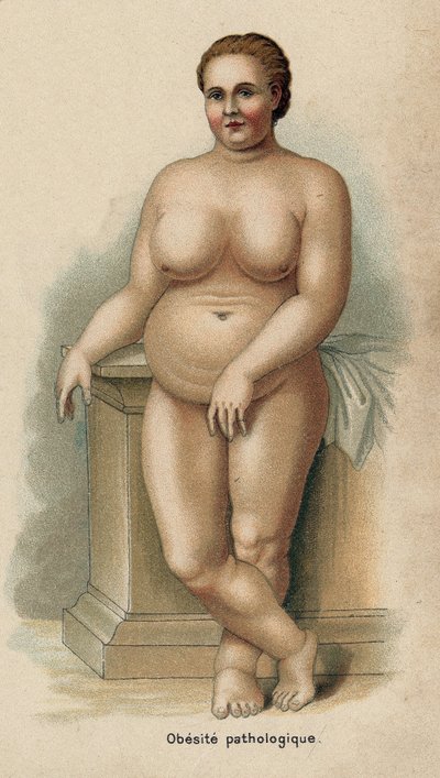 Portrét ženy s patologickou obezitou (tisk) od French School