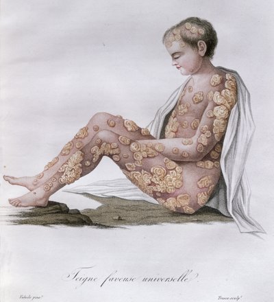 Kožního onemocnění, z knihy barona Jean Louis Alibert (1768-1837) 1838 od French School