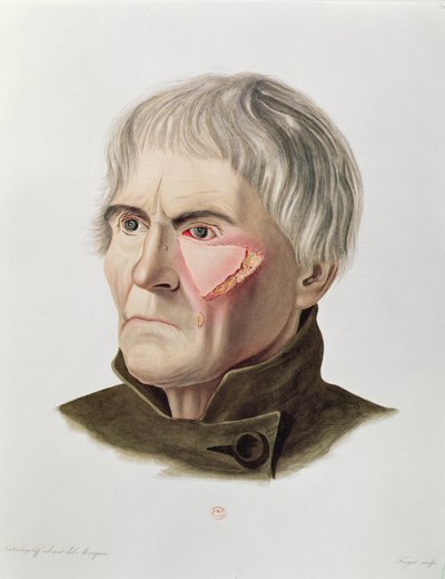 Operace kožního štěpu, z Selecta Praxis Medico-Chirurgica od Alexandra Auverta, Paříž, 1856 od French School