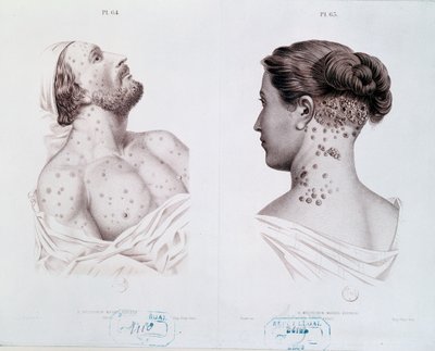Příznaky syfilis u mužů a žen, z lékařské knihy, c.1850-60 od French School
