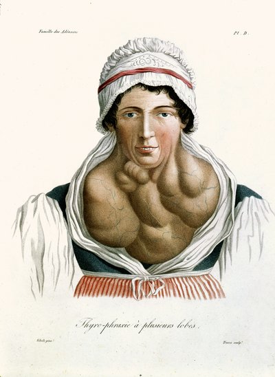Onemocnění štítné žlázy, z knihy barona Jean Louis Alibert (1768-1837) 1817 od French School