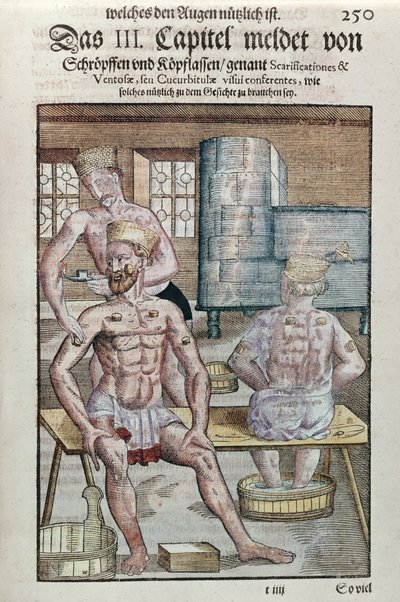 Baňkování, z Ophthalmodouleia od Georga Bartische (1535-1636) vydané v Drážďanech v roce 1583 (barevný dřevotisk) od German School