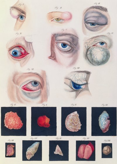 Popis vrozených očních anomálií, z Klinických popisů nemocí a zrakových vad lidského oka, Friedrich August von Ammon (1799-1861) 1838 od German School