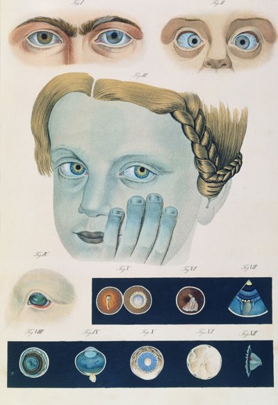 Popis vrozených očních anomálií, z Klinické reprezentace nemocí a zrakových vad lidského oka, Friedrich August von Ammon (1799-1861) 1838 od German School