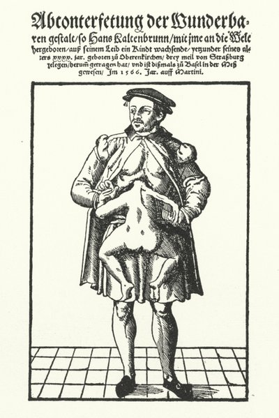 Hans Kaltenbrunn a jeho nevyvinuté siamské dvojče (rytina) od German School