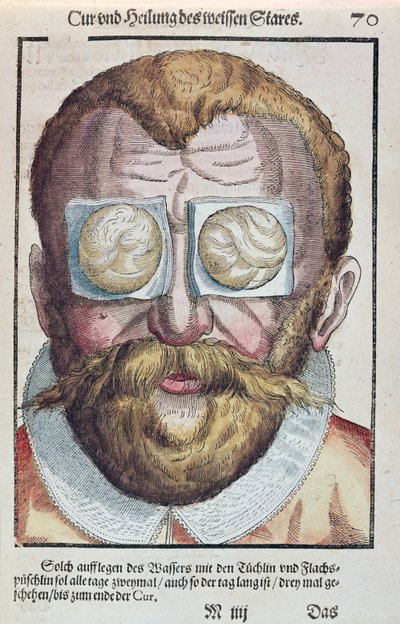 Léčba očního onemocnění, z Ophthalmodouleia od Georga Bartische (1535-1636) vydaného v Drážďanech v roce 1583 (barevný dřevořez) od German School