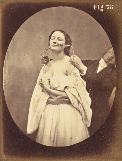 Obr. 78 od Guillaume Benjamin Duchenne