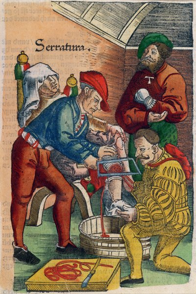Amputace, ilustrace z 