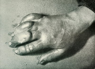 Dr. Atkinsons Frost-Bitten Hand, 5. července 1911, 1913 od Herbert Ponting