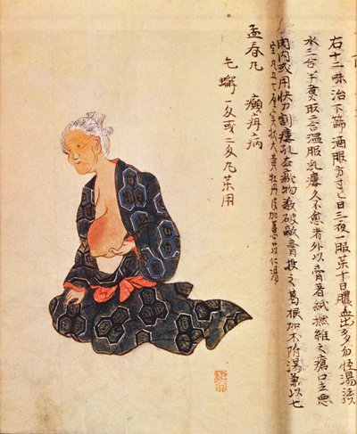 První chirurgická léčba rakoviny prsu, kterou provedl v celkové anestezii Seishu Hanaoka (1760-1836) v roce 1804 od Japanese School