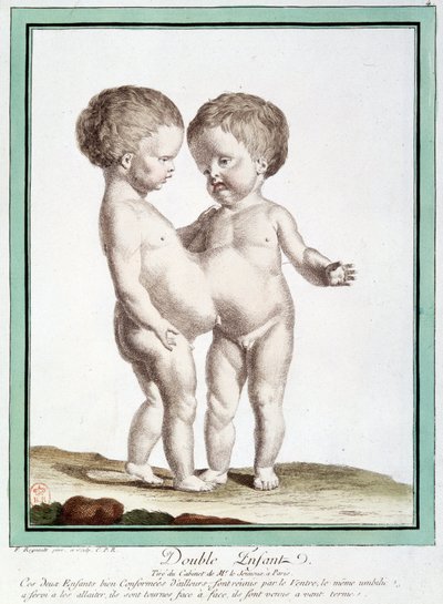 Siamské děti - v „“Odchylky přírody““ od Régnaulta od Jean Baptiste Regnault