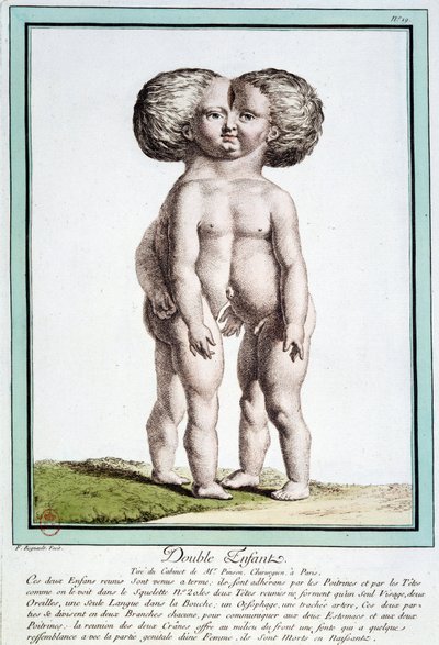 Siamské děti - v „“Odchylky přírody““ od Régnaulta od Jean Baptiste Regnault