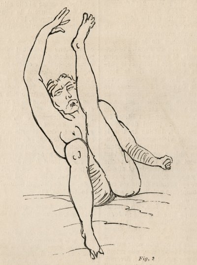 Hysterická epilepsie, záchvat, zkroucení, obr. 2 z 