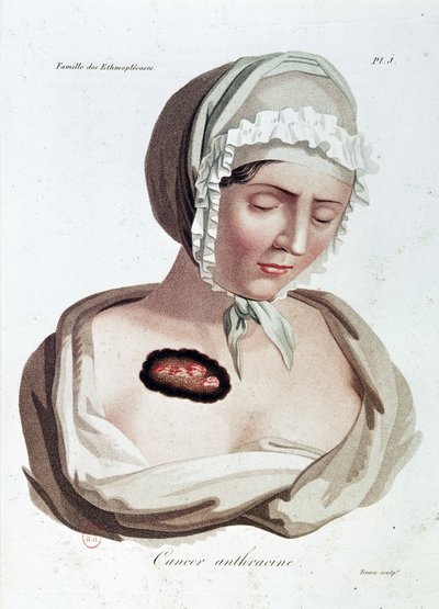 Antracinová rakovina - Alibert, B.N. od Jean Louis Alibert