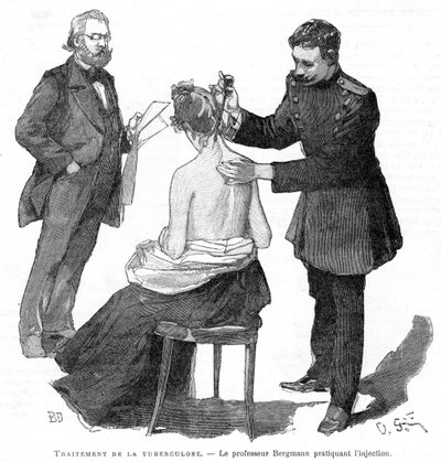 Profesor Bergmann injekčně podával pacientovi s tuberkulózou, 1891 od Unbekannt