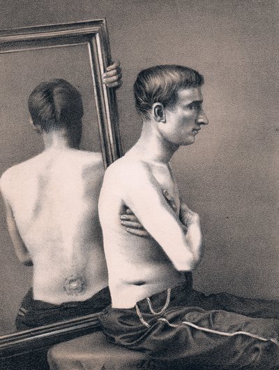 Obnova oběti střelné rány do břicha, Americká občanská válka, 1865 od Unbekannt