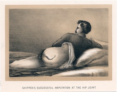 Shippens úspěšná amputace v kyčelním kloubu, Americká občanská válka, 1865 od Unbekannt