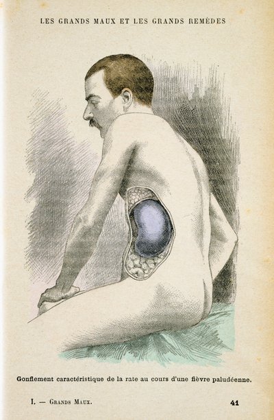 Typická zvětšená slezina pacienta s malárií, c1890 od Unbekannt