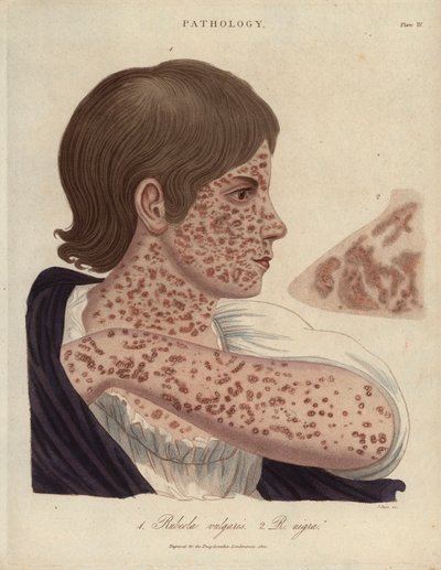 Measles and Rubeole - Litografie Johna Passe, publikovaná v "Encyclopedia Londinensis" Johna Wilkese, edice J.Adlard, Londýn od Unbekannter Künstler