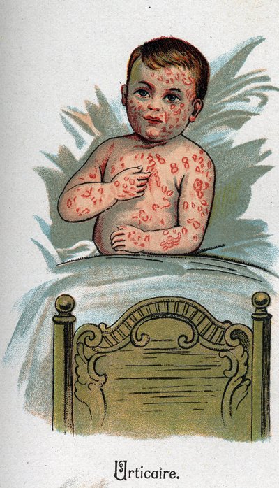 Dětské nemoci: Kopřivka. In „Nová přírodní medicína“ od F.E. Bilze. od Unknown artist