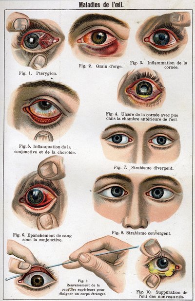 Nemoci oka. „Nová přírodní medicína“ od F.E. Bilze. od Unknown artist